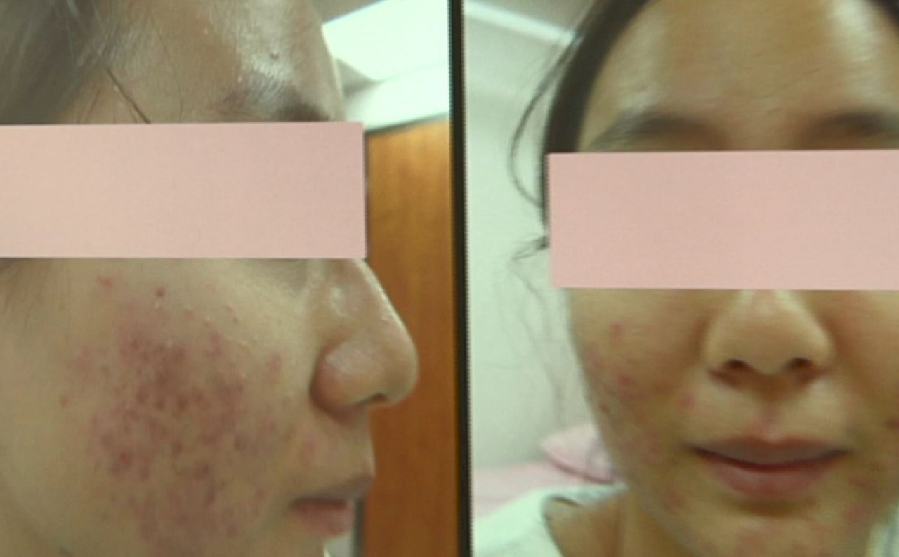 VIDEO: Wearing masks for long periods can lead to skin problems
