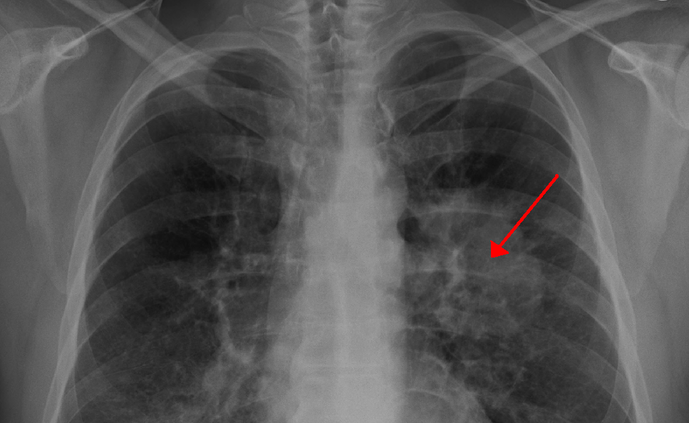 Health minister urges those with family history and heavy smokers to seek lung cancer screening